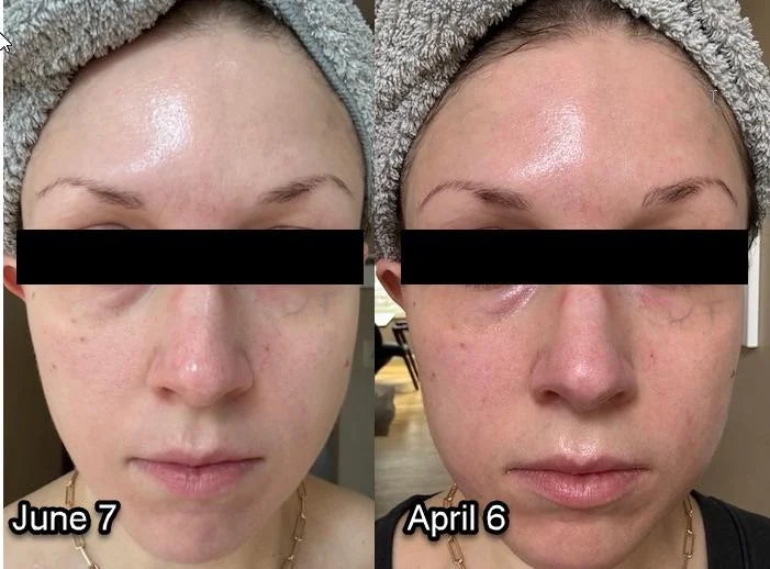 Mascarilla LED Facial, Antiarrugas,Acne y Rejuvenecimiento