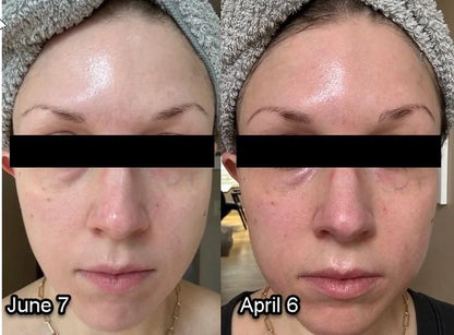 Mascarilla LED Facial, Antiarrugas,Acne y Rejuvenecimiento
